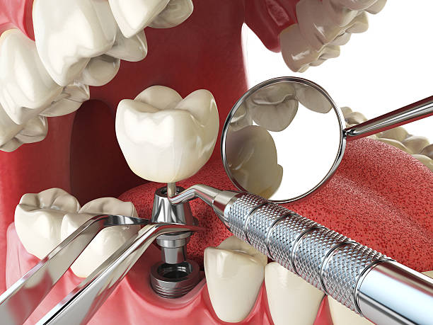 Best Emergency Dentist for Lost Fillings or Crowns in Cascade Chipita Park, CO